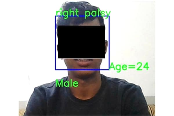 detecting facial palsy